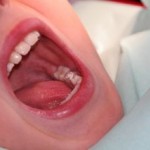 Dişler Genel Sağlığı Etkiler